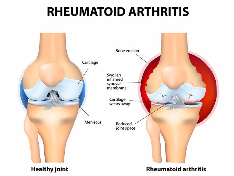 Rheumatoid Arthritis